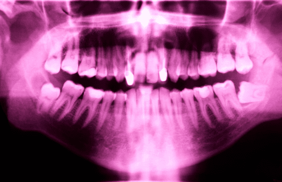 X-ray shows patient needs teeth extraction to improve dental health in Chelsea MA